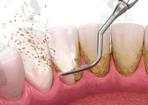 牙烟渍洗牙能洗掉吗?牙齿烟渍洗牙用超声波还是喷砂好?