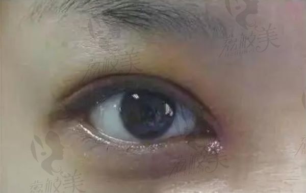 手术后