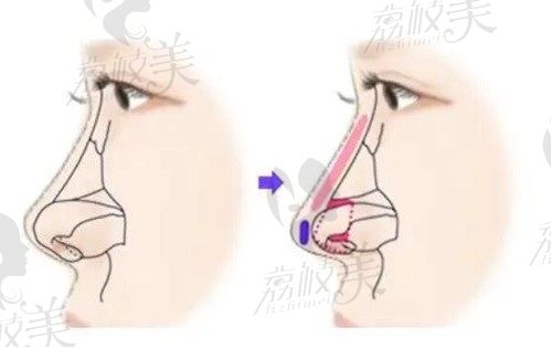 深圳八大处张辉医生擅长隆鼻整形，自体软骨鼻综合只要31580元起