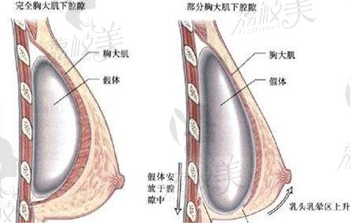 重庆陈德法隆胸怎么样？擅长高定丰胸技术好案例超多很动感