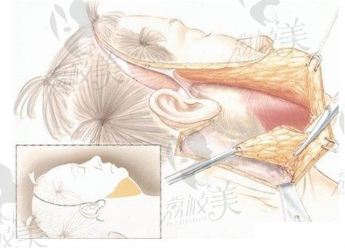 袁強拉皮醫(yī)生技術(shù)如何?看了袁強拉皮手術(shù)全過程才知袁強博士技術(shù)很好