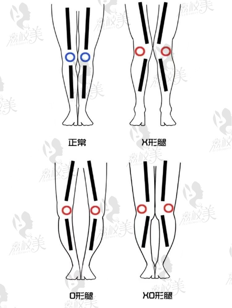 卢九宁直腿术谁做过？看我花3万多做的成效还不错很有用