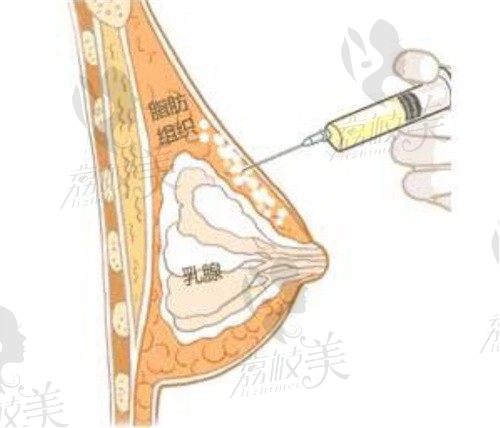 重庆好美孔令杰做自体脂肪丰胸20多年了,脂肪隆胸价格12000+自然饱满