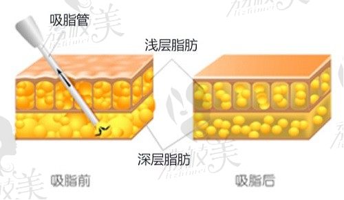 冯斌北京吸脂专家简介：吸脂技术声名远扬