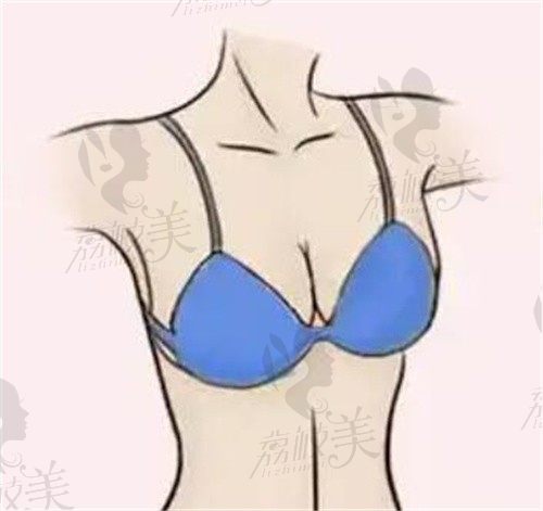 重慶華美曹勇做巨乳縮小手術(shù)價(jià)格56000+，縮胸+乳房下垂矯正同步實(shí)現(xiàn)