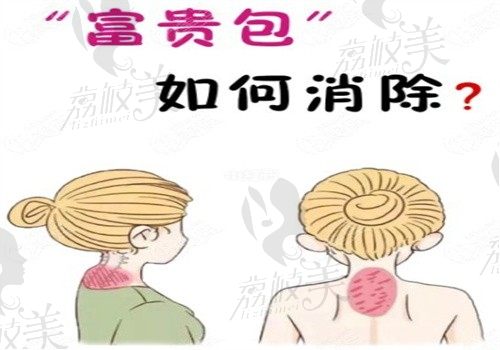 钻石超塑做富贵包成效好吗?挺好的,价格6000起溶脂紧肤速度快