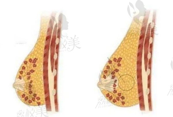 杭州薇琳郭同荣自体脂肪丰胸2.5w元起，脂肪成活率高胸型好看