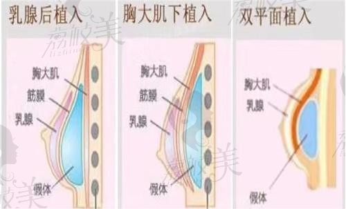 赵亚均假体隆胸怎么样？内窥镜双平面植入定制丰胸经验足真的好