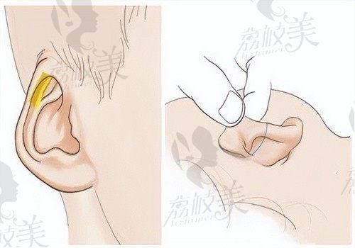 于曉波耳朵修復(fù)價(jià)格15000起，在成都八大處做小耳畸形修復(fù)實(shí)例多