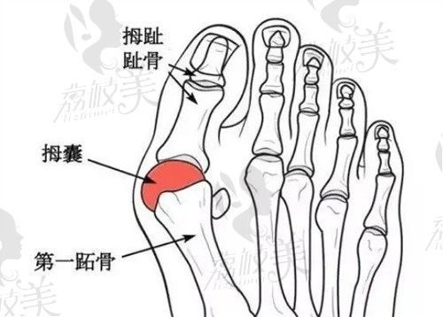 李昕宇医生拇外翻手术好吗?技术挺好的做拇外翻不会复发值得预约