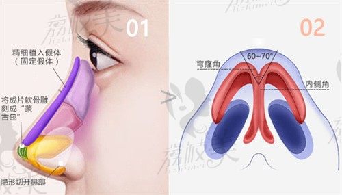 西安藝星陳天杰做耳軟骨隆鼻價(jià)格32800元起,風(fēng)格自然術(shù)后不怕捏