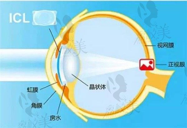 evoicl晶体植入术的优势和劣势是啥？这种手术能管一辈子吗？