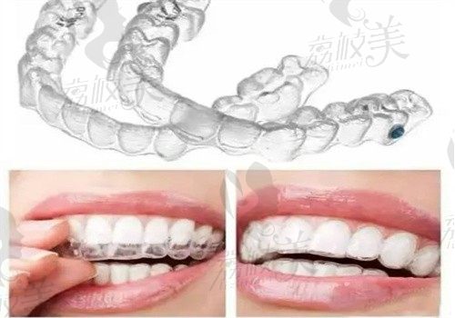 隐形牙套是什么材质做的？生物陶瓷\高分子纳米材料\热塑性聚合物等均是