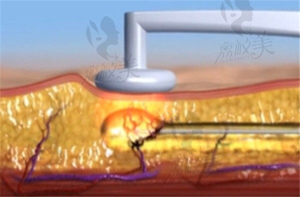 黄金微雕和维密脂雕哪个好？射频溶脂VS超声溶脂该如何选择？