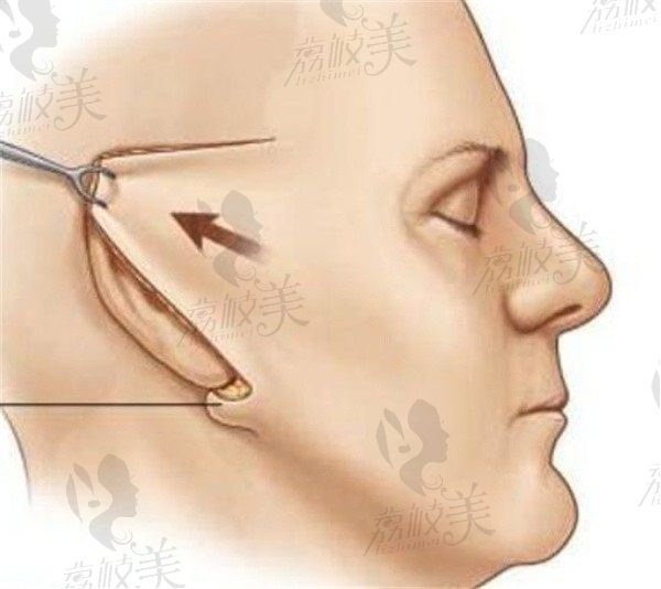 锚定韧带拉皮价格4万元起，和大拉皮的区别在于原理和维持时间不同