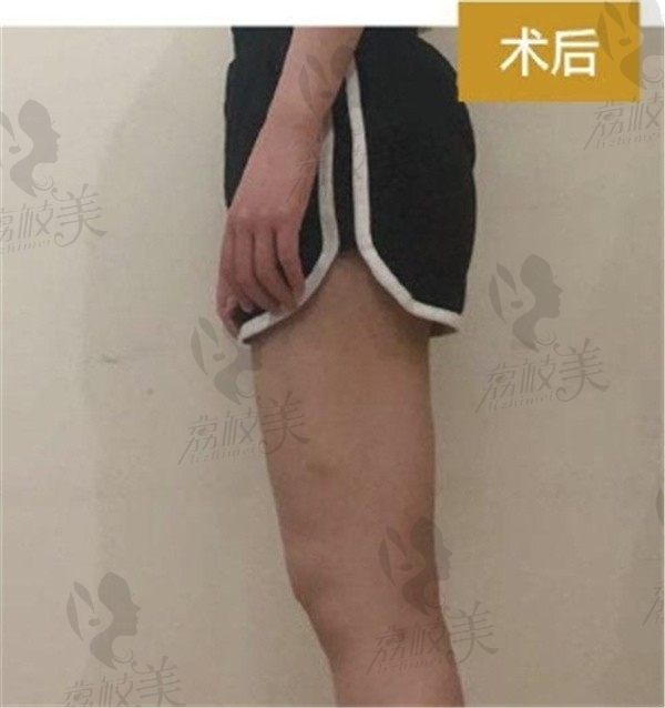 西安王俊河吸脂是出了名的好，找他做了大腿吸脂从此告别大象腿