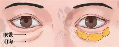 郑州眼袋修复王杨医生简介:王杨眼袋修复卧蚕真的很好且手术成功率高