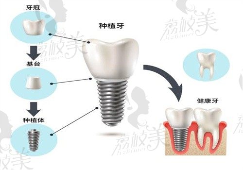 哈尔滨优诺博士口腔种牙价格:易普莱2480/科威尔4080/诺贝尔9800起一颗