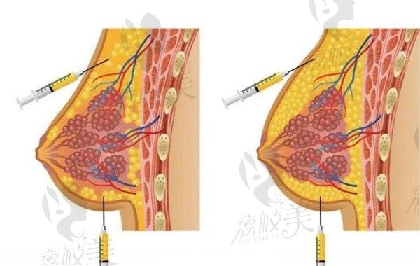 广州闫爱跃自体脂肪丰胸成活率在95%，内窥镜操作让术后形态更自然