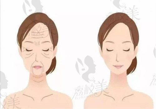 上海艺星张洋洋医生额纹填充技术好，消除抬头纹后更显年轻了