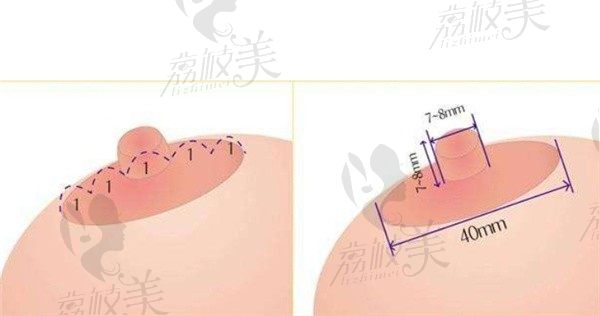 南京美莱夏建军缩胸手术成效好，本文分享技术优势+价格+怎么预约