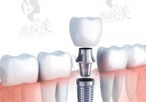 韩国奥齿泰种植体型号有哪几种？有GS TS系列\SS系列\US系列\MS系列4种