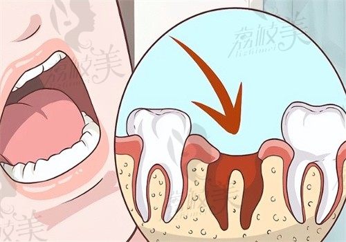 牙科拔牙收费价目表2025：含公立和私立牙科乳牙\松动牙\智齿拔除价格