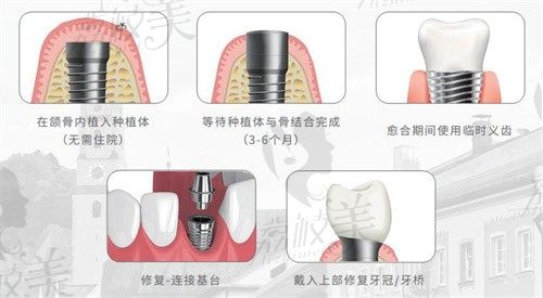 喀什中诺口腔医院种植牙