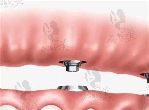 大连康美佳口腔价格表2025，种植牙2k+牙齿矫正7k+补牙200+
