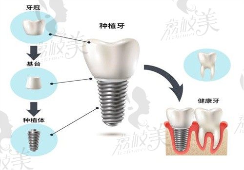 溧阳牙卫士种植牙多少钱？单颗1670/半口4W/全口5W起价格合理
