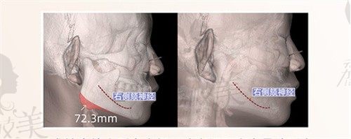 黃大勇改臉型屬于哪種風(fēng)格?從黃大勇下頜角磨骨案例來看他做改臉型是自然風(fēng)格