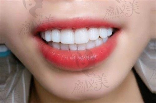 白银市牙科价目表2025年:种植牙/牙齿矫正/拔牙/补牙/洗牙/根管治疗价格都不贵