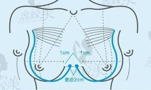 重慶陳德法隆胸收費(fèi)6-12W，做假體隆胸整形資歷高/經(jīng)驗(yàn)足/效果真