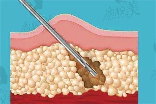 北京达美如艺吸脂价格表:EL极速精雕吸脂3800+,托马斯立方柔性吸脂6800+