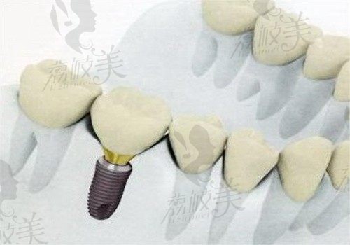 2025年上饶看牙价格表更新，有洗牙\补牙\拔牙\种牙\正畸收费情况