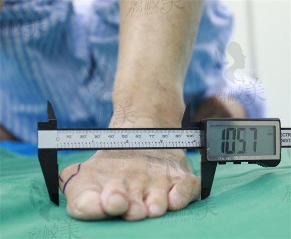 沈阳马文足科是正规医院吗？擅长微创大脚骨手术技术超正规附价格表