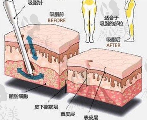 深圳黄海侠2w起的独创双针流抽脂技术，让术后超平整不在凹凸不平