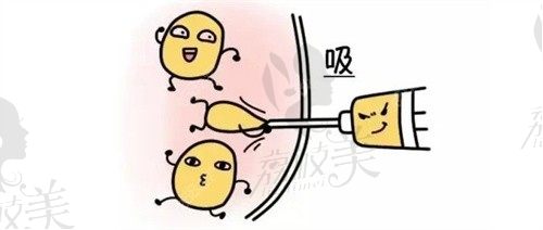 银川吸脂手术价格是多少钱?腰腹吸脂6000+,大腿吸脂6800+,手臂吸脂4500+