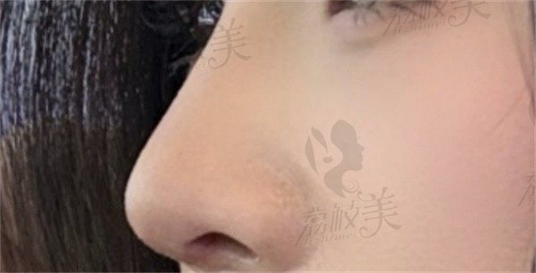 手术后
