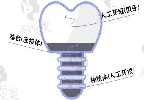 天津常乐口腔种牙价格:韩系植体1980/皓圣3280/瑞士ITI3280起