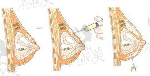 劉成勝脂肪豐胸怎么樣?不僅成活率高還沒(méi)出現(xiàn)過(guò)失敗案例更不是打廣告出來(lái)的