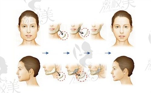 【磨骨手術(shù)價(jià)格表2025】下頜角磨骨5萬起,顴骨磨骨4萬起,磨骨修復(fù)8萬起