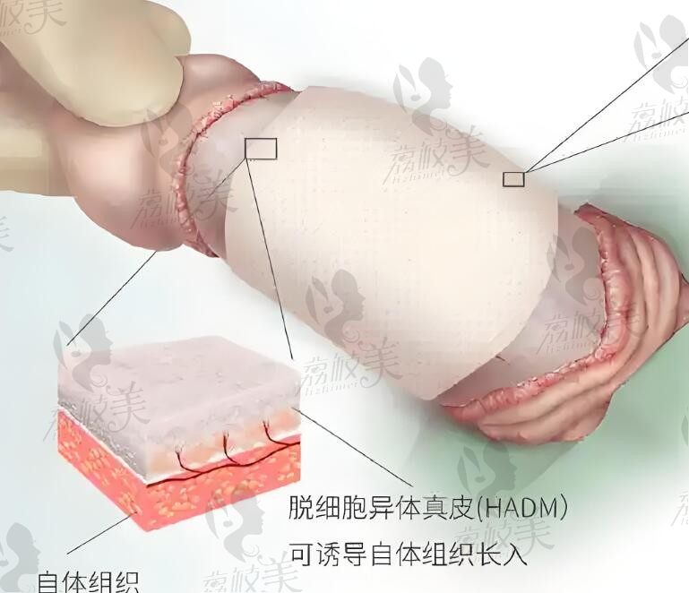 生物補(bǔ)片增粗手術(shù)多少錢？2025年價(jià)格表顯示收費(fèi)國產(chǎn)生物補(bǔ)片26000+進(jìn)口35000+