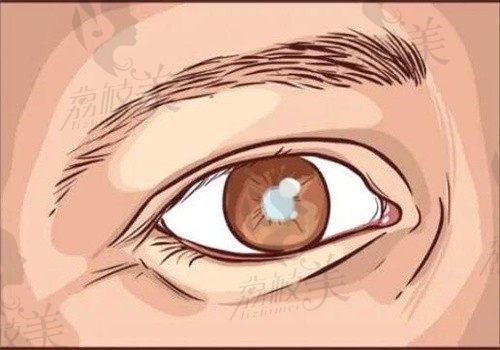 河北省白内障手术晶体报销比例是多少？30%~40%的比例在综合医院可以实现