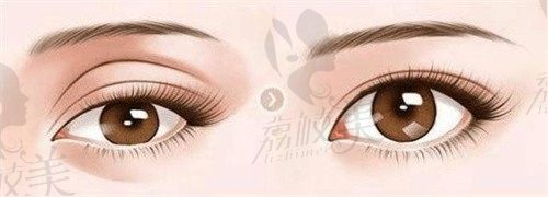 曹思佳修复双眼皮好吗?个人简介显示曹思佳双眼皮技术好且十分擅长修复手术