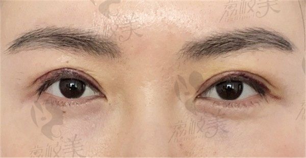 手术后