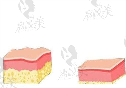 维密金雕属于什么档次？高端档次也是馒化修复新技术效果好