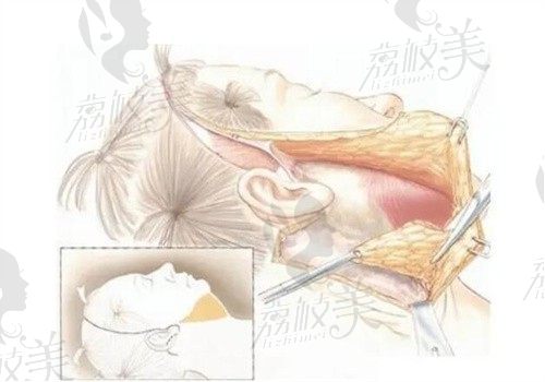 穆寶安在哪家醫(yī)院坐診？在加減美坐診v美減齡面部提升術(shù)切口隱蔽還能深層提升