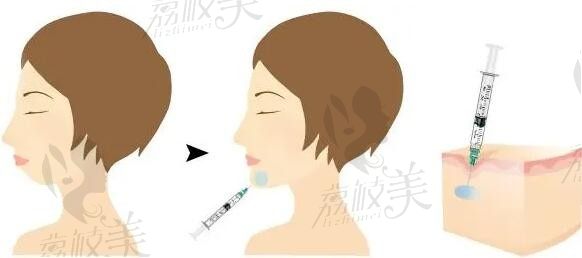 2025麦瑞格骨颜针价格是多少钱？一支几毫升哪家医院有打的靠谱吗