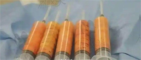 亲历海南华美医学美容赵晓兰做吸脂塑形记录，从